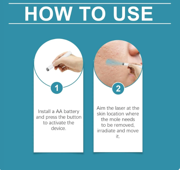 Xorita Non-Invasive Mole and Wart Removal Pen